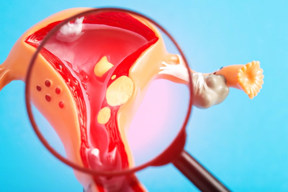 Why managing uterine fibroids before ICSI is important